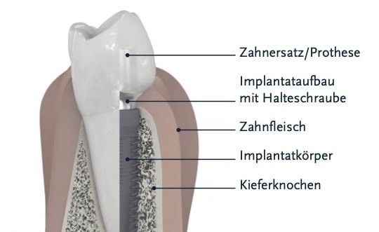 Zahnimplantate Wiesbaden